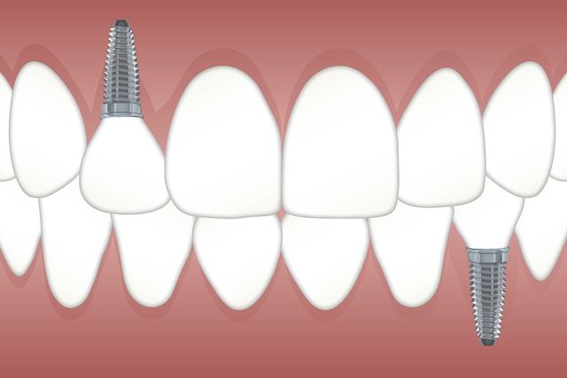 sagligagel-dis-implanti-nedir-nasili-yapilir873