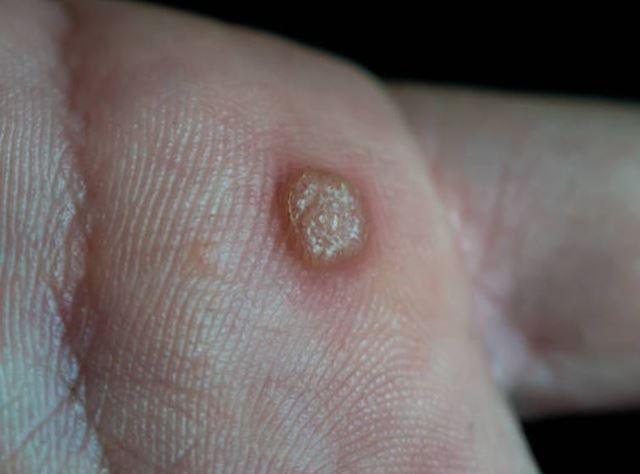 sagligagel-tehlikeli-hpv-virusu-nedir-hpv-virusu-tedavisi