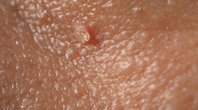 sagligagel-tehlikeli-hpv-virusu-nedir-hpv-virusu-tedavisi111