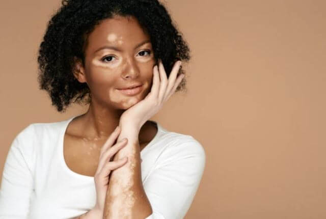 sagligagel-vitiligo-nedir-vitiligo-tedavisi-2022