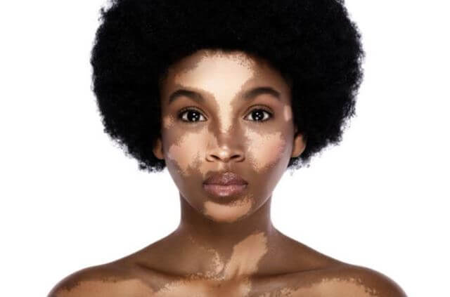 sagligagel-vitiligo-nedir-vitiligo-tedavisi-20222
