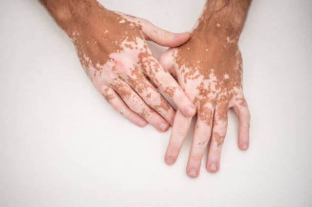 sagligagel-vitiligo-nedir-vitiligo-tedavisi-20224