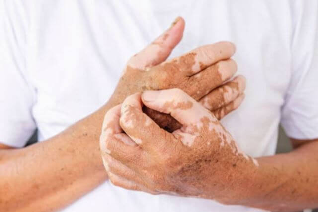 sagligagel-vitiligo-nedir-vitiligo-tedavisi-20225