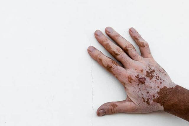 sagligagel-vitiligo-nedir-vitiligo-tedavisi-20226