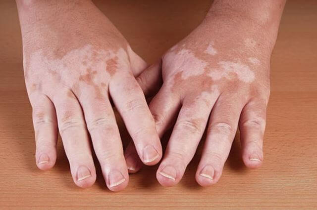 sagligagel-vitiligo-nedir-vitiligo-tedavisi-20227