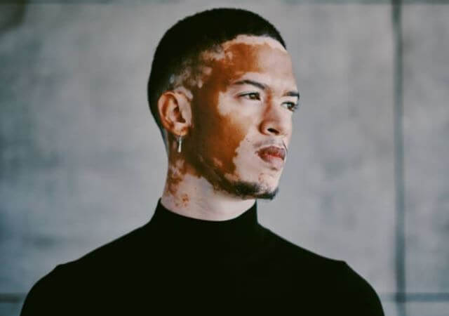sagligagel-vitiligo-nedir-vitiligo-tedavisi-202278