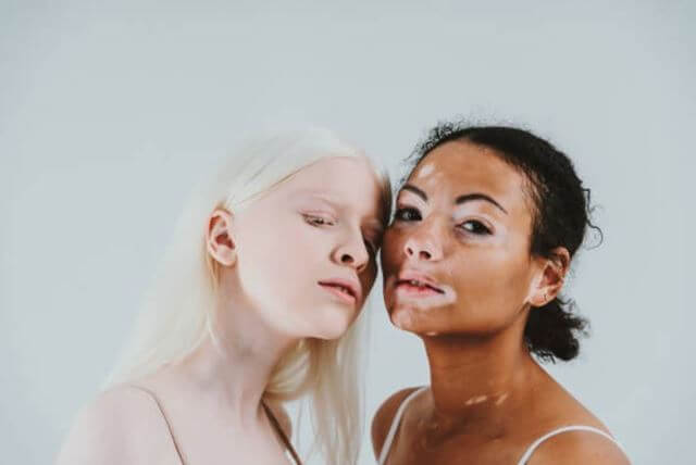 sagligagel-vitiligo-nedir-vitiligo-tedavisi-202287