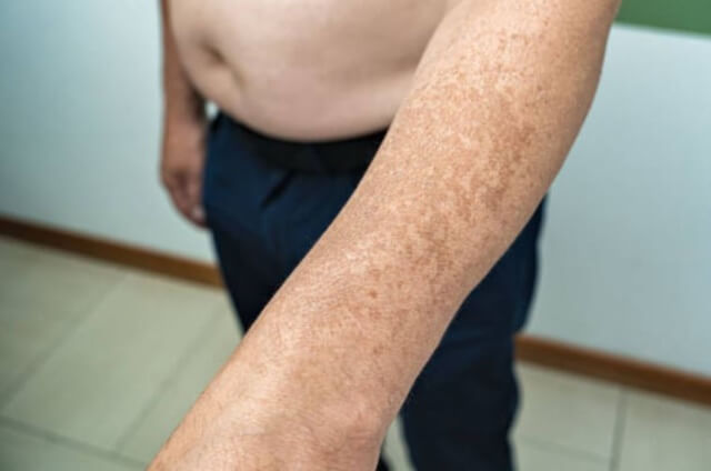 sagligagel-actinoma-jel-fiyat-2022-actinoma-jel-ne-ise-yarar-4