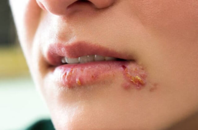 sagligagel-asiviral-krem-ne-ise-yarar-4