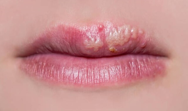 sagligagel-asiviral-krem-ne-ise-yarar-5