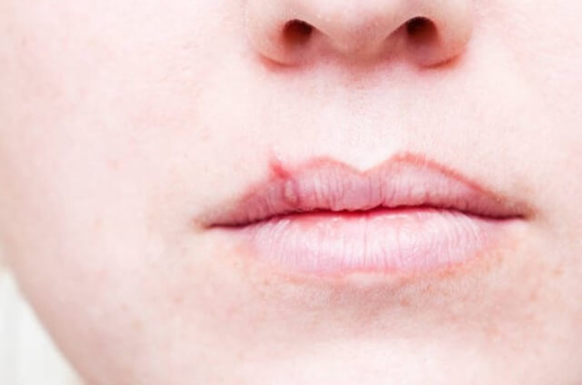 sagligagel-asiviral-krem-ne-ise-yarar-8