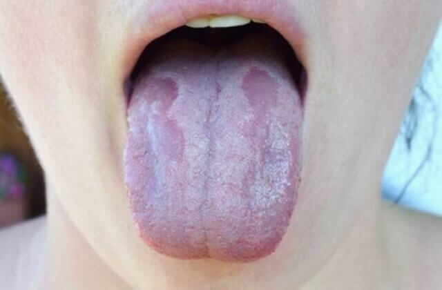 sagligagel-candida-mantari-ilaci-isimleri-nelerdir-0
