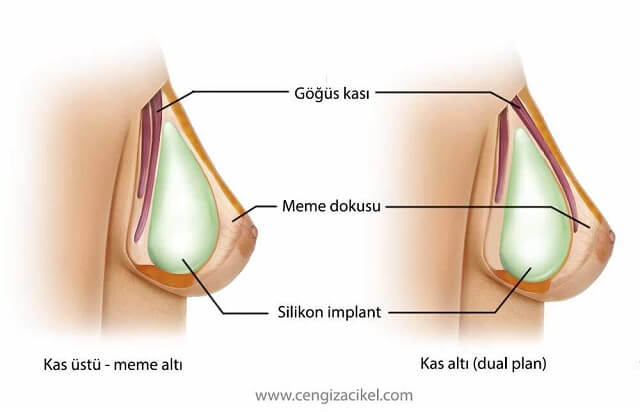 sagligagel-silikon-implant-ile-meme-buyutme-ameliyati