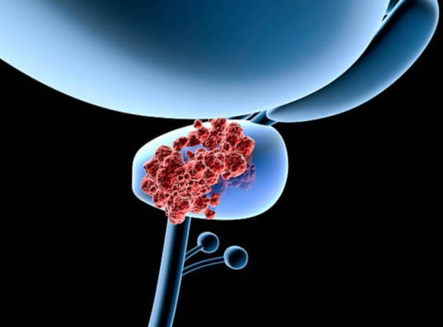 sagligagel-prostat-ameliyatindan-sonra-sperm-gelir-mi-1