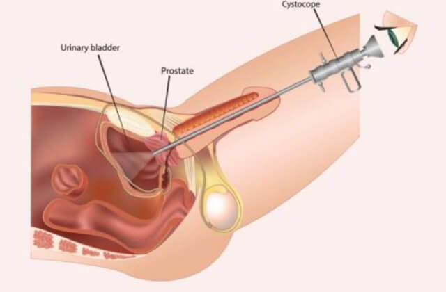 sagligagel-prostat-ameliyatindan-sonra-sperm-gelir-mi-2