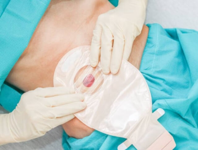 sagligagel-stoma-torbasi-nedir-5