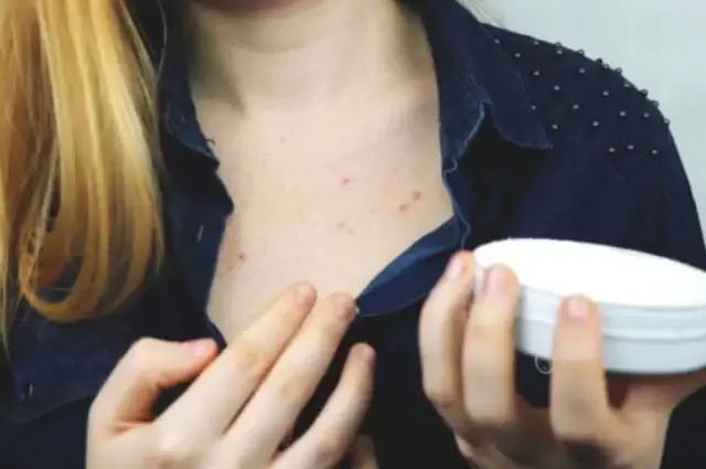sagligagel-5-baslikta-permetrin-krem-nedir-6