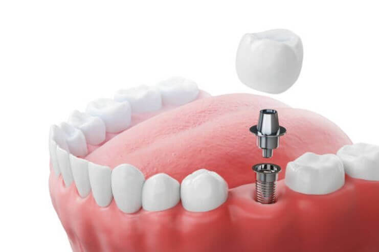 sagligagel-ankara-implant-tedavisi-1