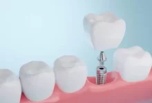sagligagel-ankara-implant-tedavisi-5