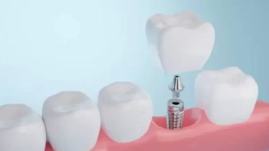 sagligagel-ankara-implant-tedavisi-5