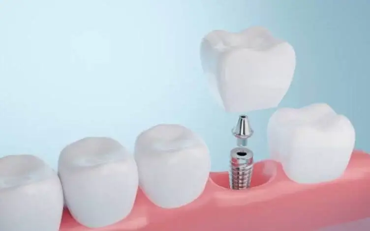 sagligagel-ankara-implant-tedavisi-5