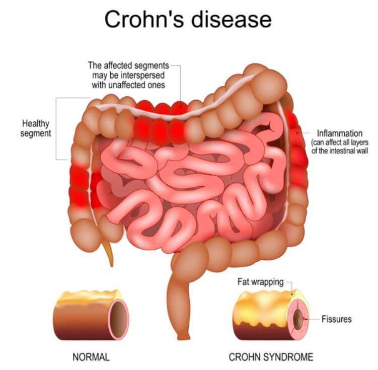 sagligagel-crohn-hastaligi-nasil-anlasilir-3sagligagel-crohn-hastaligi-nasil-anlasilir-3