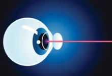 sagligagel-katarakt-ameliyati-sonrasi-problemler-3