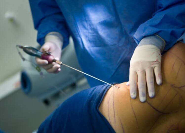 sagligagel-lipo-ameliyatindan-sonra-4